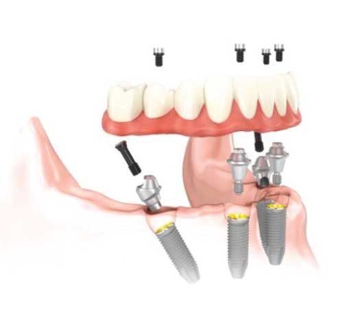 Fixed Screw-In Denture